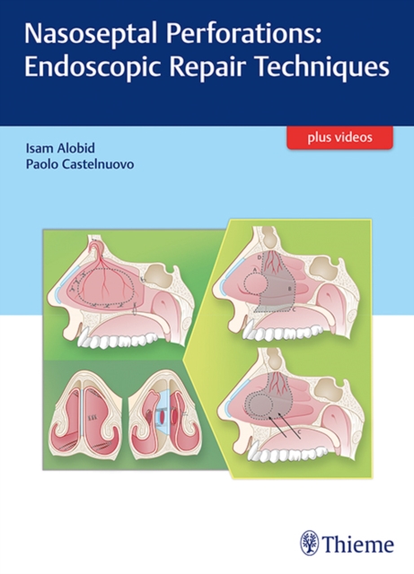 Nasoseptal Perforations: Endoscopic Repair Techniques, Hardback Book