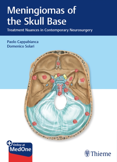 Meningiomas of the Skull Base : Treatment Nuances in Contemporary Neurosurgery, Mixed media product Book