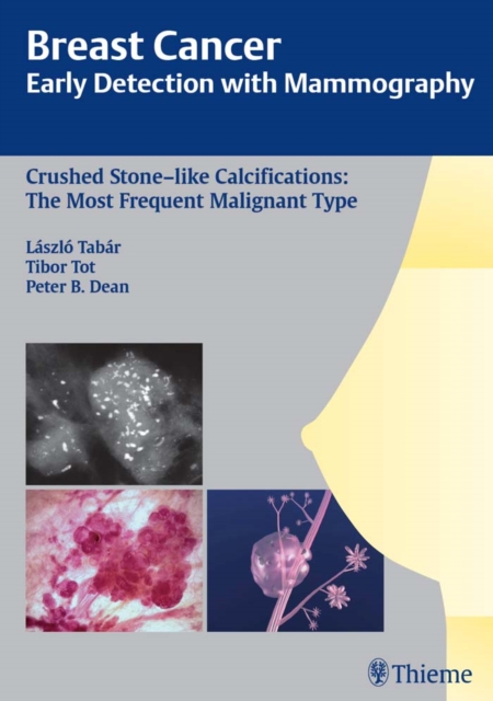 Breast Cancer: Early Detection with Mammography : Crushed Stone-like Calcifications: The Most Frequent Malignant Type, EPUB eBook