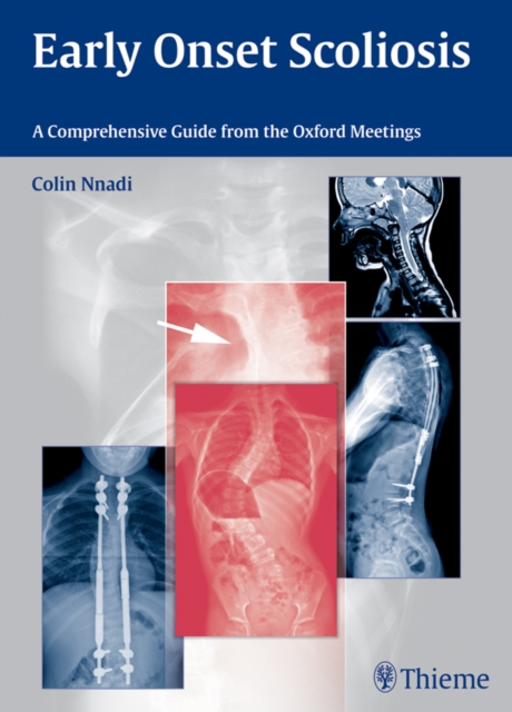 Early Onset Scoliosis : A Comprehensive Guide from the Oxford Meetings, EPUB eBook