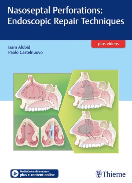 Nasoseptal Perforations: Endoscopic Repair Techniques, EPUB eBook