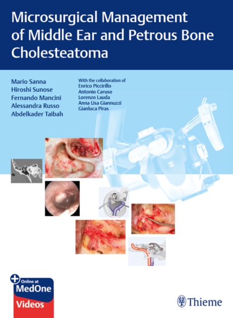 Microsurgical Management of Middle Ear and Petrous Bone Cholesteatoma, EPUB eBook