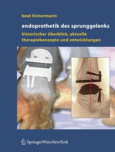 Endoprothetik DES Sprunggelenks : Historischer Uberblick, Aktuelle Therapiekonzepte Und Entwicklungen, Book Book