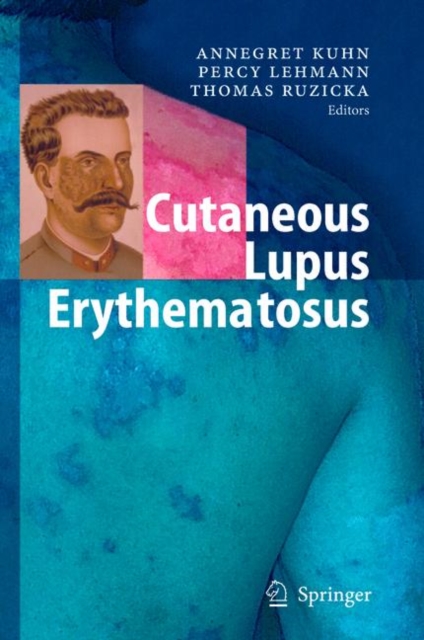 Cutaneous Lupus Erythematosus, Hardback Book