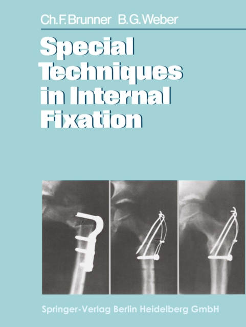Special Techniques in Internal Fixation, PDF eBook
