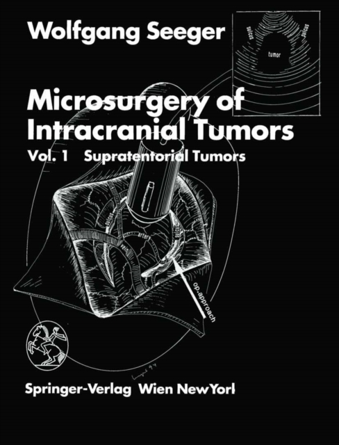 Microsurgery of Intracranial Tumors : Vol 1: Supratentorial Tumors, PDF eBook