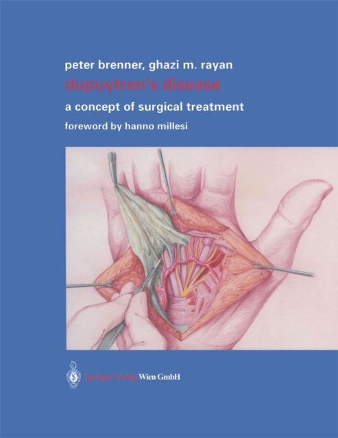 Dupuytren's Disease : A Concept of Surgical Treatment, PDF eBook