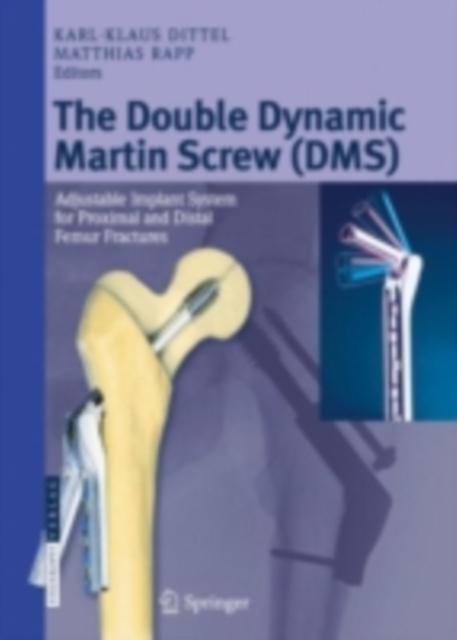 The Double Dynamic Martin Screw (DMS) : Adjustable Implant System for Proximal and Distal Femur Fractures, PDF eBook