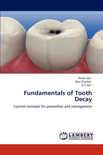 Fundamentals of Tooth Decay, Paperback / softback Book