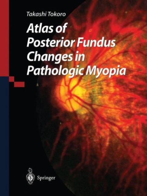 Atlas of Posterior Fundus Changes in Pathologic Myopia, Hardback Book