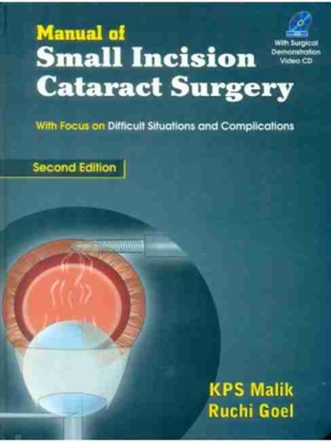 Manual of Small Incision Cataract Surgery, Hardback Book