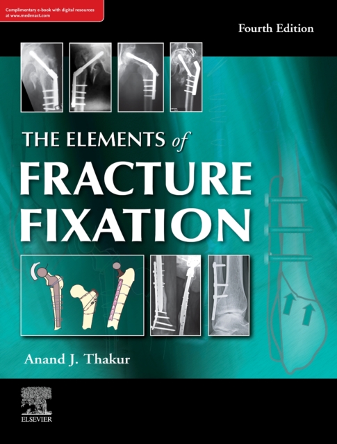 The elements of fracture fixation, 4e, EPUB eBook