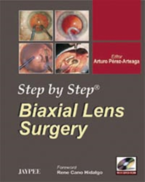 Step by Step: Biaxial Lens Surgery, Paperback / softback Book