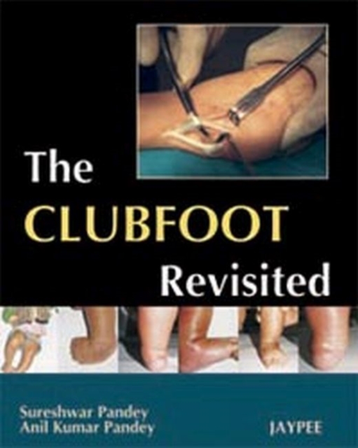 The Club Foot Revisited, Paperback / softback Book