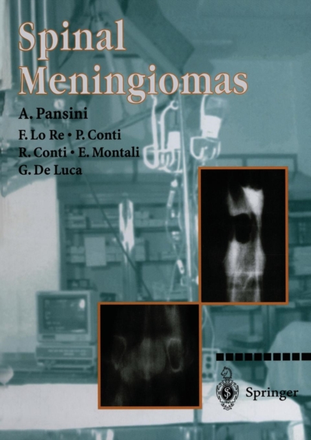 Spinal Meningiomas, Paperback / softback Book