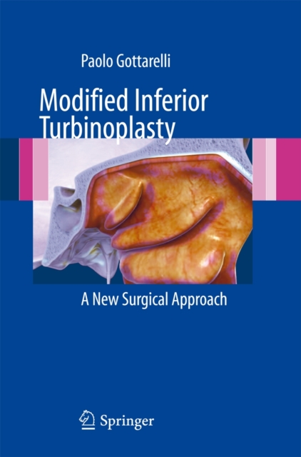Modified Inferior Turbinoplasty : A new surgical approach, Paperback / softback Book