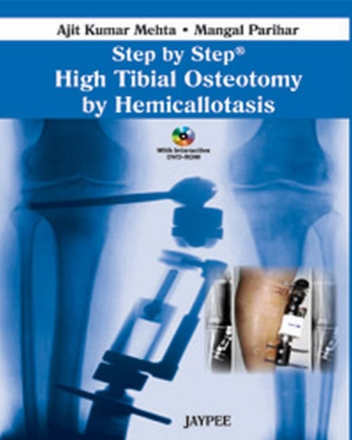 Step by Step: High Tibial Osteotomy by Hemicallotasis, Mixed media product Book