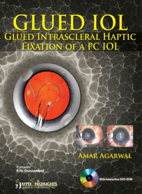 GLUED IOL : Glued Intrascleral Haptic Fixation of a PC IOL, Hardback Book