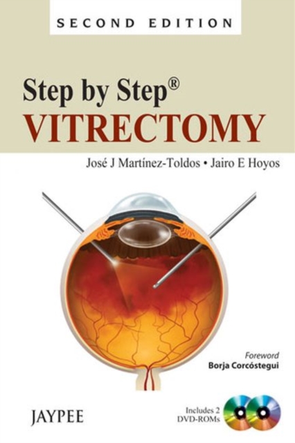 Step by Step: Vitrectomy, Paperback / softback Book