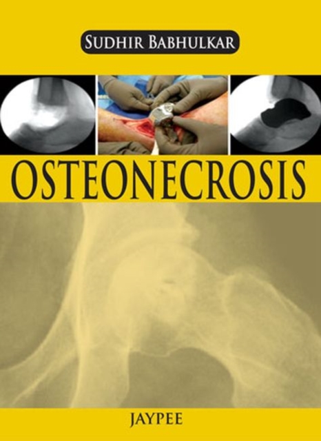 Osteonecrosis, Paperback / softback Book