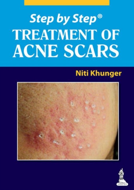Step by Step: Treatment of Acne Scars, Paperback / softback Book