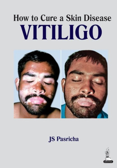 How to Cure a Skin Disease: Vitiligo, Paperback / softback Book