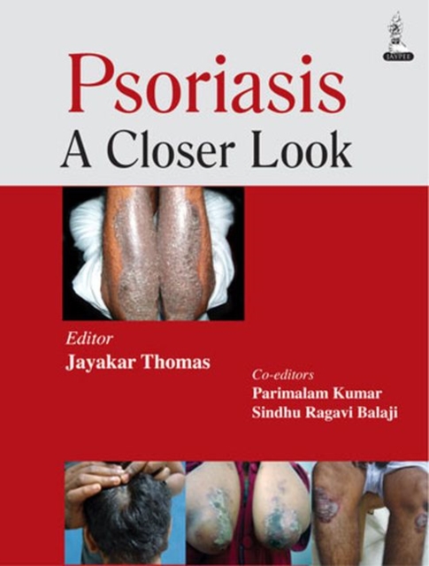 Psoriasis : A Closer Look, Paperback / softback Book