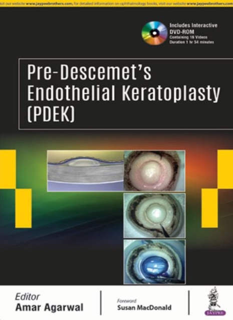 Pre-Descemet’s Endothelial Keratoplasty (PDEK), Hardback Book