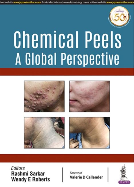 Chemical Peels: A Global Perspective, Paperback / softback Book