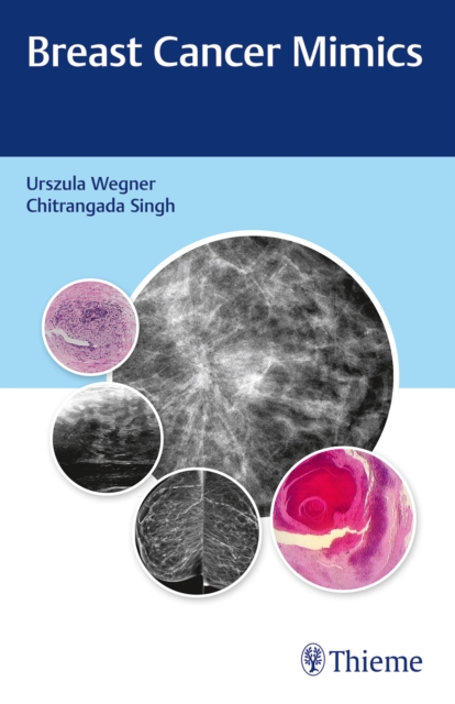 Breast Cancer Mimics, Paperback / softback Book