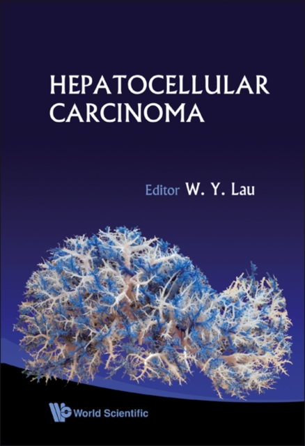 Hepatocellular Carcinoma, Hardback Book