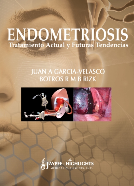 Endometriosis: Tratamiento Actual y Futuras Tendencias, Hardback Book